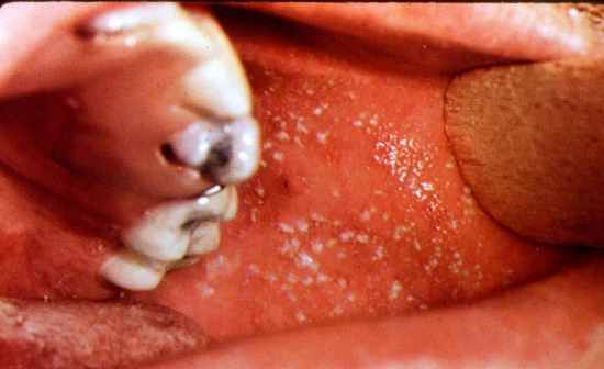 Measles Rash - Pictures, Symptoms, Causes, Treatment