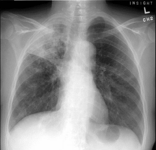 left lung atelectasis