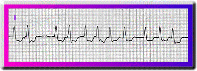 EKG Interpretation - Flashcards