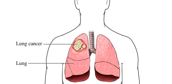 Lung Cancer Quizzes & Trivia