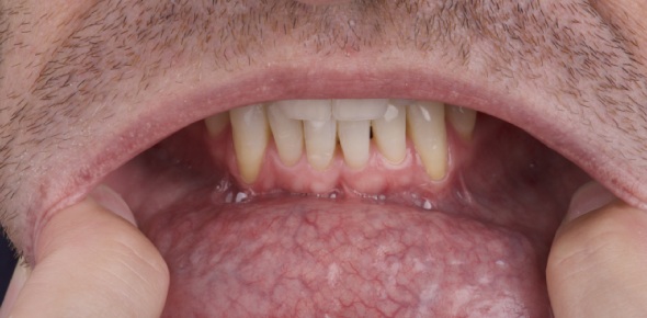 Oral Cancer Quizzes & Trivia