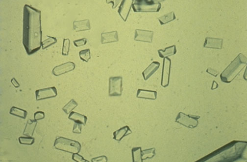 amorphous urate crystals in urine. The pH of the urine specimen