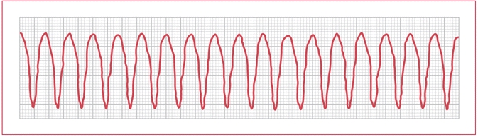 ekg-practice-strips-printable-with-answers-tutore