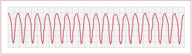 ekg-practice-strips-printable-with-answers-tutore