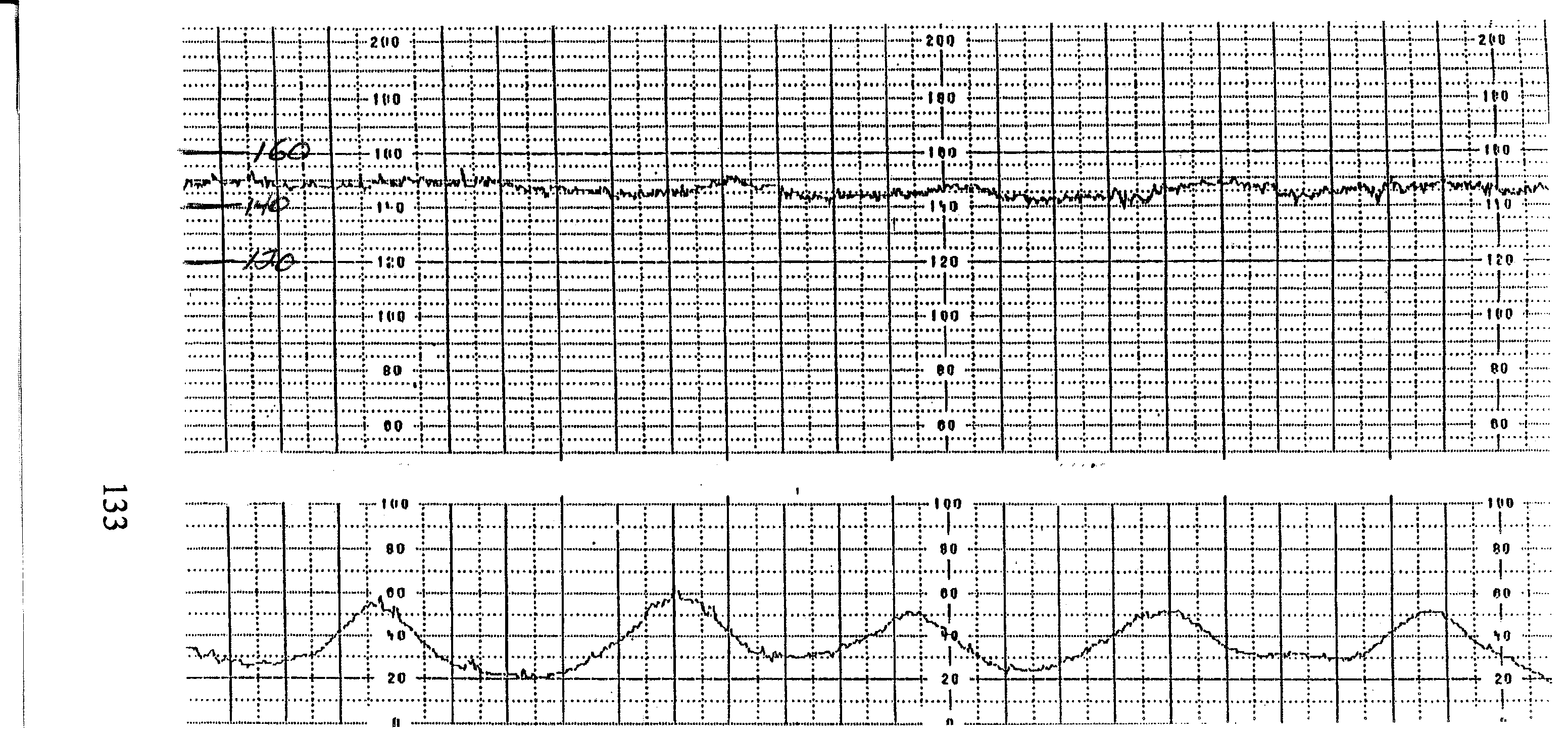 What are the rate and duration of the contractions seen on