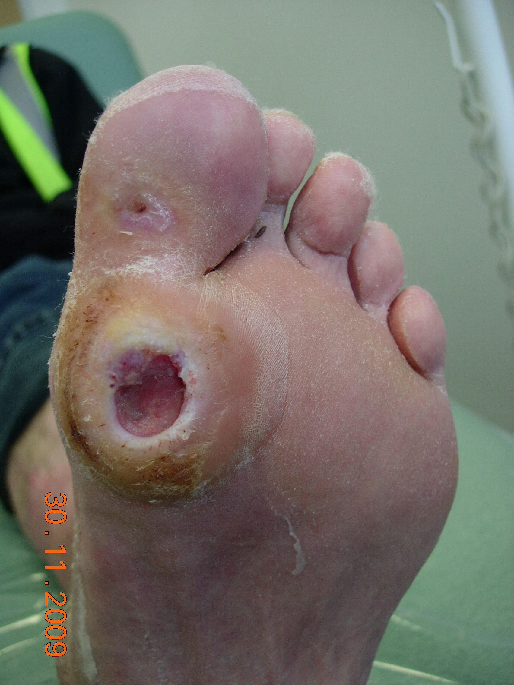 diabetic foot