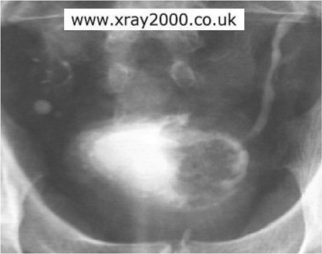 Radiographic PathologyUrinary System ProProfs Quiz