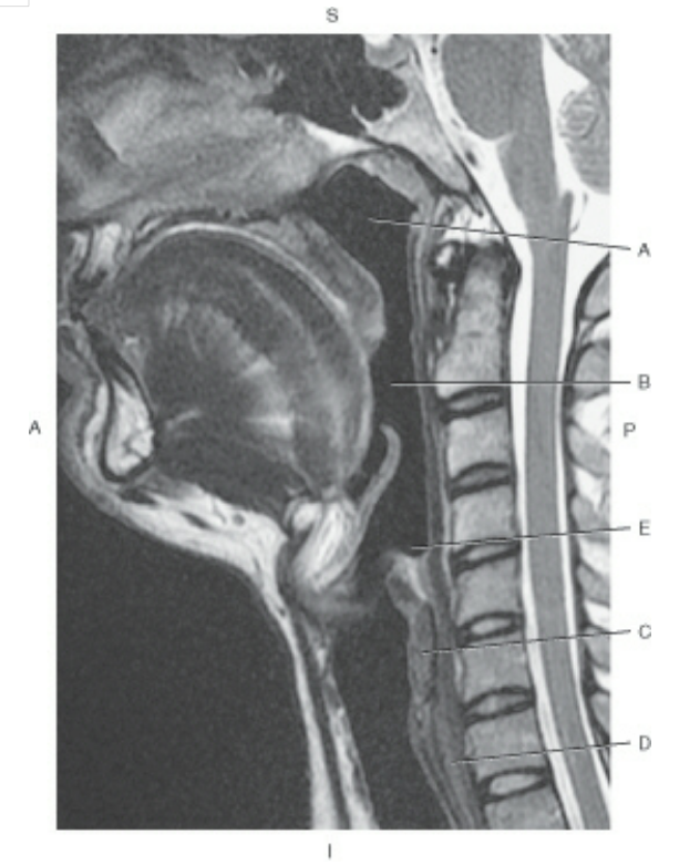 Identify Arrow Point Of MRI!