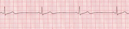 Image: https://www.proprofs.com/api/ckeditor_images/Sinus_Bradycardia.jpg