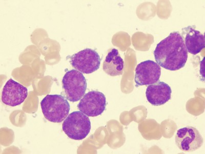 FAB Classifications of Leukemias with Images - Flashcards
