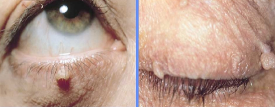 Ocular Disease I, Eyelid Flashcards by ProProfs
