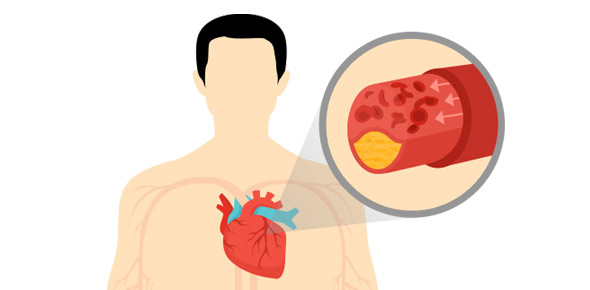 Myocardial Infarction Quizzes & Trivia