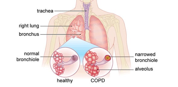 COPD Quizzes & Trivia