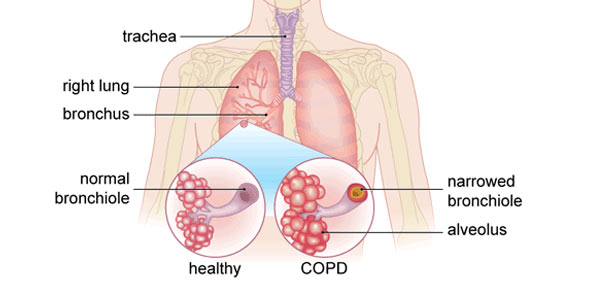 Provide The Generic Name (Asthma/COPD Review)