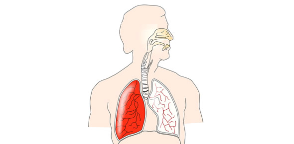 Pulmonary Tuberculosis Stokke N180