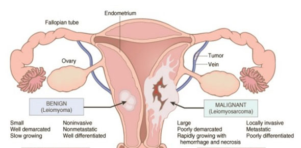 Neoplasia Quizzes & Trivia