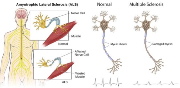 Amyotrophic Lateral Sclerosis Quizzes & Trivia