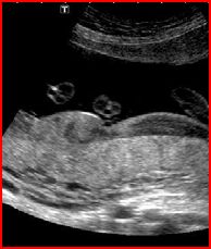 Ob Placenta And Umbilical Cord - Quiz