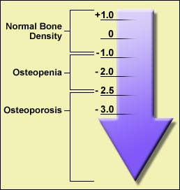 Osteoporosis Bone Disease Quiz