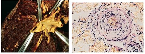 Developmental And Vascular Pulmonary Disease