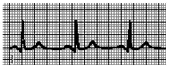 Sem1mini3 - ECG MCQ