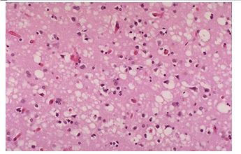 Neurodegen Dz Myopathy MCQ