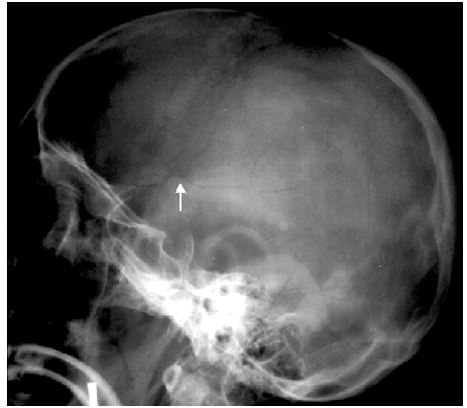 Skull And Cranial Fossa - Face And Scalp