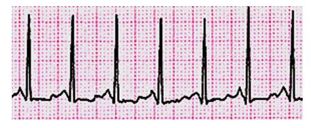 Block 3 EKG Strips And Stuff - Quiz