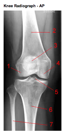 Заострение межмыщелковых возвышений коленного сустава рентген. Рентген большеберцовой кости. Краевой перелом надмыщелка бедренной кости. Рентген бедренной кости большеберцовой.